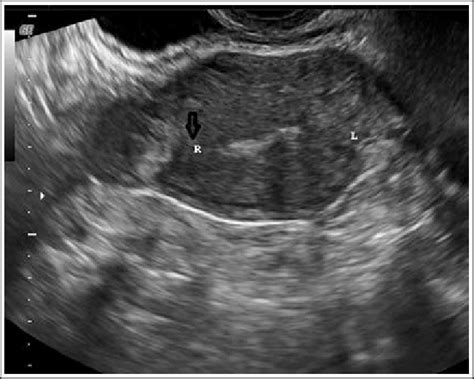 Coronal view of the fundus of the uterus on transvaginal ultrasound... | Download Scientific Diagram