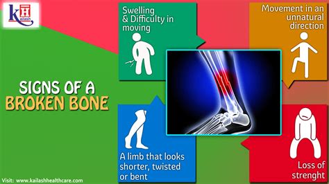 4 Signs of a Broken Bone