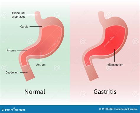 Gastritis, an Inflammation, Irritation, or Erosion of the Lining of the Stomach. Medical Vector ...