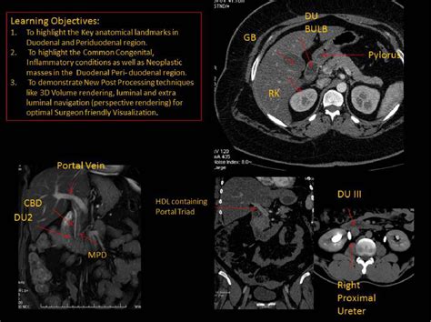 Figure 28 from Imaging Anatomy of Hepatoduodenal Ligament: Revisited | Semantic Scholar