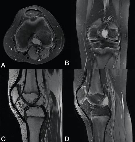 A Ganglion Cyst in the Anterior Cruciate Ligament of a 13-Year-Old Boy | Cureus