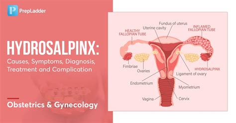 Hydrosalpinx: Causes, Symptoms, Diagnosis, Treatment and Complications