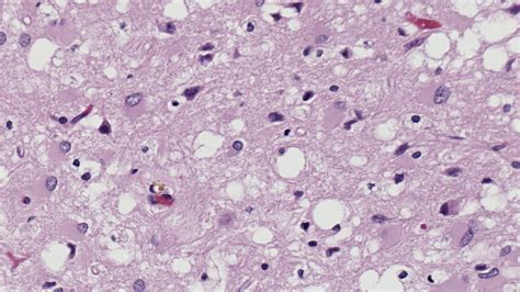 A Brain-Destroying Prion Disease Is Becoming More Common, Study Finds