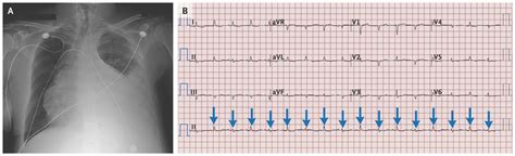 Electrical Alternans with Pericardial Tamponade | NEJM