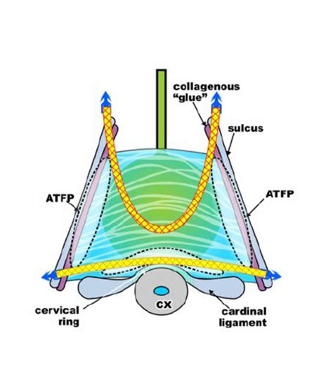 Cardinal ligament and ATFP TFS operations for cystocele repair ...