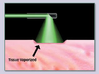 Green light laser surgery for prostate