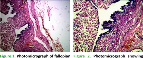 Hilus cell hyperplasia of fallopian tubes: a rare and incidental ...