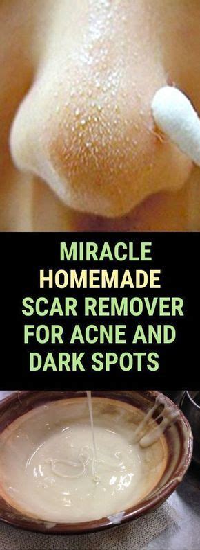 Pin by Gloria Leyva on home remedies | Acne dark spots, Scar removal, Homemade acne treatment