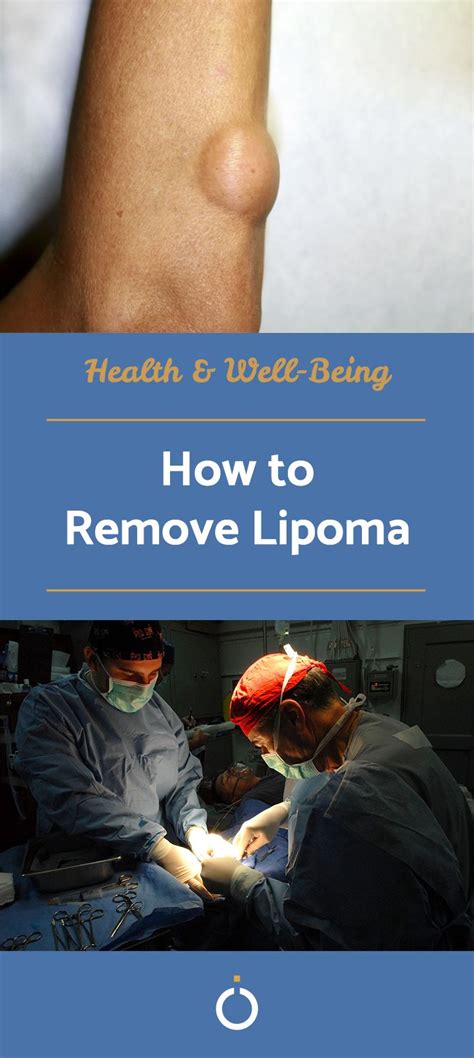 How to Remove Lipoma | How to remove, Lipoma removal, Healthy lifestyle ...