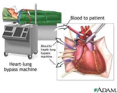 Lung transplant surgery - Heart & Lung Transplant