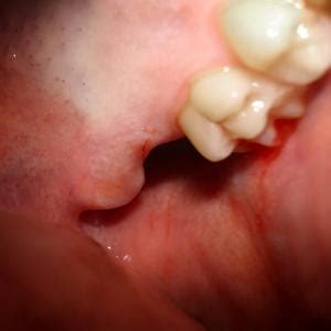 Infection in Gum After Tooth Removal | IYTmed.com