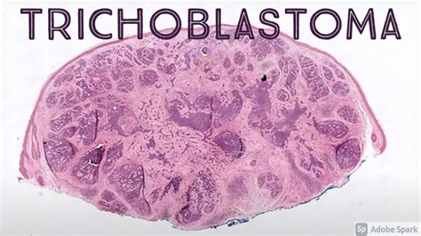Trichoblastoma & Trichoepithelioma: Benign Hair Follicle Tumor Mimic of ...