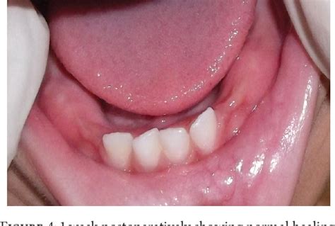 Figure 4 from Mucocele in Lower Lip as a Result of Improper Use of ...