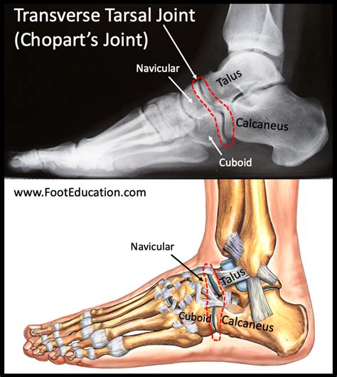 Transverse Tarsal Joint Injury-Sprain - FootEducation