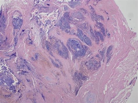 Long-Term Complete Remission of Recurrent Unresectable Thymoma Type B2 under Somatostatin ...