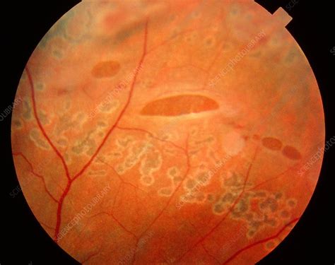 Ophthalmoscopy view of torn retina in eye - Stock Image - M155/0391 - Science Photo Library