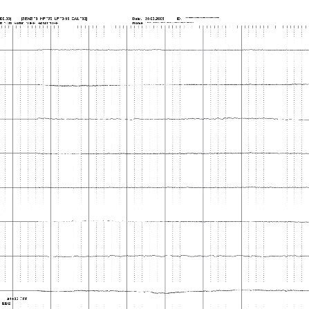 Electroencephalography (EEG) shows the isoelectric line in brain ...