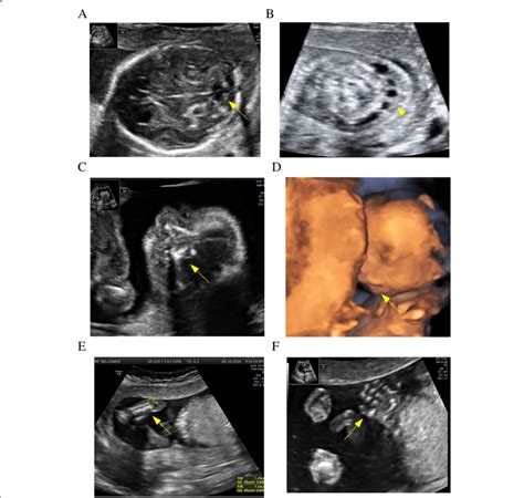 Abnormal foetal image in ultrasound examination at 18 weeks of... | Download Scientific Diagram