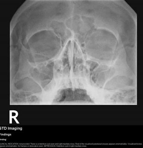 Maxillary Sinus Retention Cyst - slidesharetrick