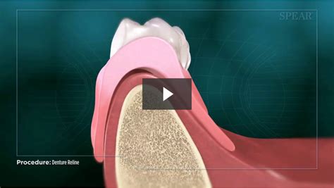 Denture Reline - Cosmetic Dentistry