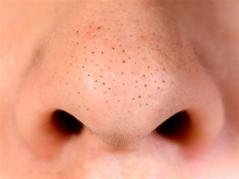 Nose Blackheads: 15 Best Ways to Remove Black Clogged Pores on Nose