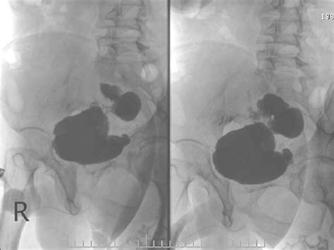 Cystogram showing a vesicointestinal fistula. | Download Scientific Diagram