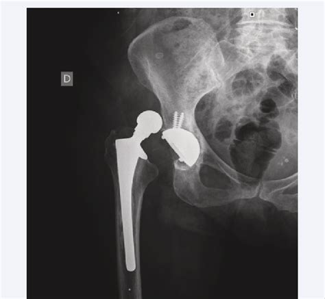 a Preoperative X-ray of recurrent instability of total hip replacement. | Download Scientific ...