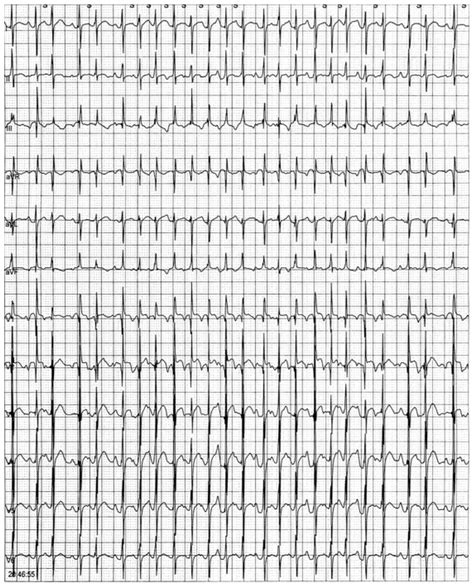 Multifocal Atrial Tachycardia