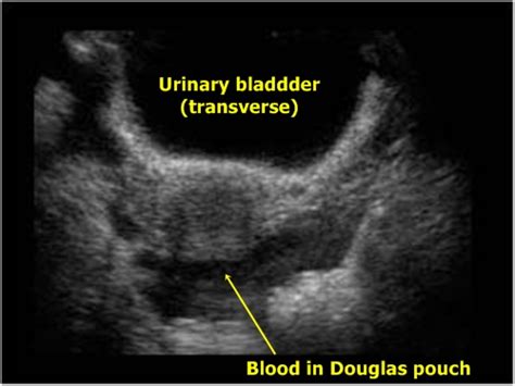 Intra-abdominal Fluid - Sonography | Medicína, nemoci, studium na 1. LF UK