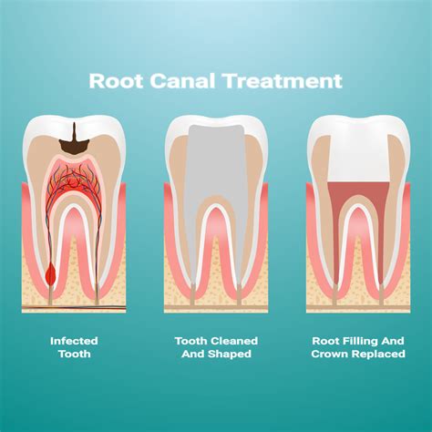 Root Canal Infection