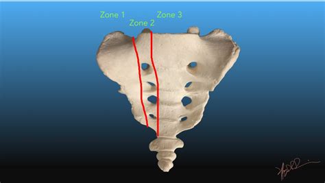 Denis Classification of Sacral Fractures | UW Emergency Radiology