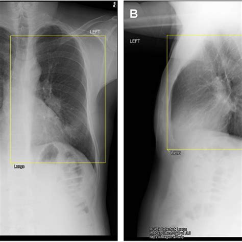 Posterior-Anterior (A) and lateral chest X-ray (B) demonstrating... | Download Scientific Diagram