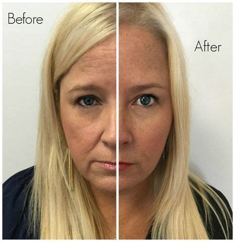 How to Get Rid of Wrinkles in 10 Days | Facial fillers, Face wrinkles, Botox eyes