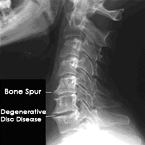 Spinal Arthritis and Bone Spur Treatment in Dallas, TX