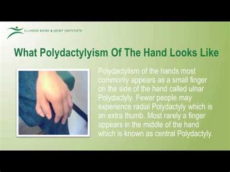 Polydactyly - Causes, Classification, Diagnosis, Treatment | Diseases 2024