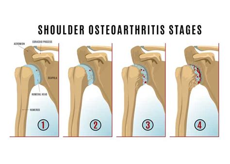 Glenohumeral Joint Degeneration