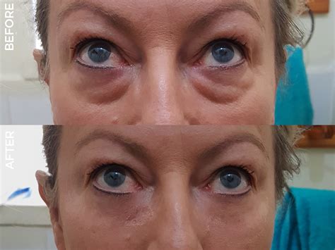 INSTANT BEAUTY, STUNNING RESULTS Instantly Ageless immediately tightens ...