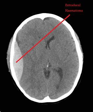 www.LeedsNeurosurgery.com | Patient Information | Extradural Haematoma