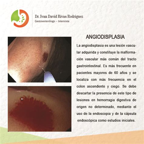 Angiodisplasia – Gastro Mérida