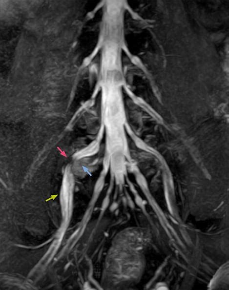 MRI nerve visualization informs surgery | FieldStrength | Philips