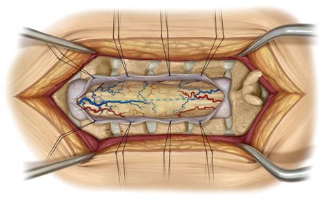 Intramedullary Spinal Cord Tumor | The Neurosurgical Atlas