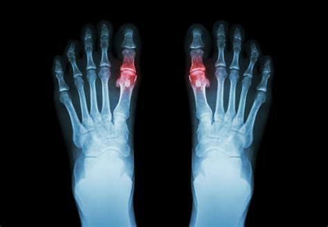 Gout , Rheumatoid arthritis ( Film x-ray both foot and arthritis at first metatarsophalangeal ...