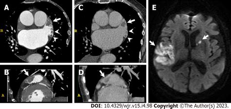 Left atrial appendage thrombus. An 85-year-old woman with congestive ...