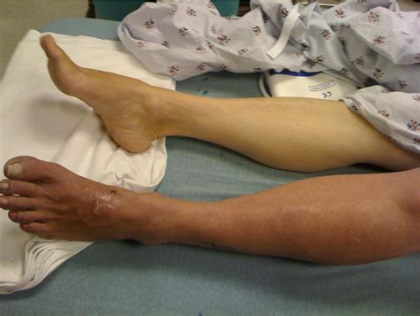 A Case of a Painful Swollen Leg - Annals of Emergency Medicine