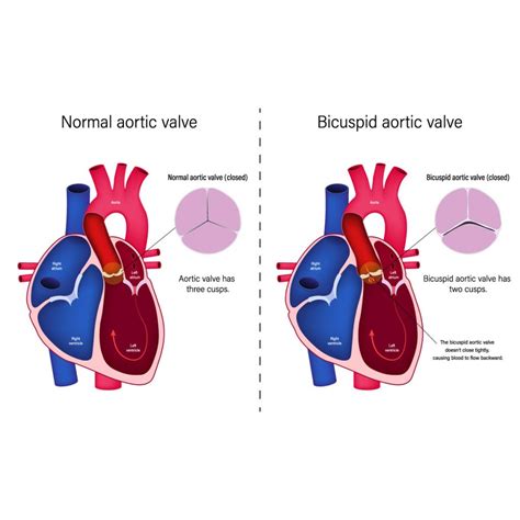 8 Common Symptoms For Aortic Valve Regurgitation | Vejthani