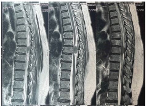 Functional outcome in intradural extramedullary tumor patients after surgical tumour excision ...