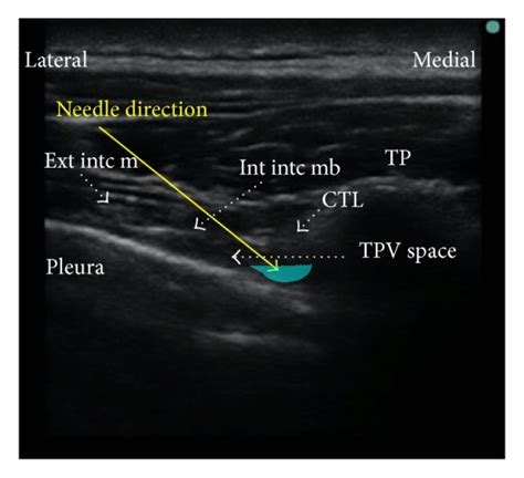 Thoracic paravertebral block, transverse in line technique. Needle... | Download Scientific Diagram