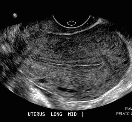 Endometrium Ultrasound