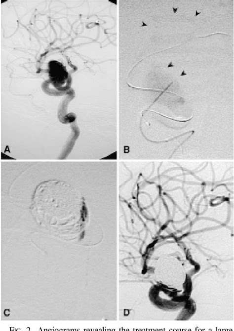 Figure 2 from Intrasaccular combination of metallic coils and onyx liquid embolic agent for the ...