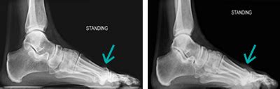 First MTP Cheilectomy | FootCareMD